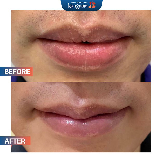 Trước và sau khi thu mỏng môi