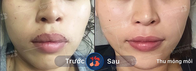 Bạn T.H tự tin khoe trên cá nhân của mình sau khi làm mỏng môi được 1 tháng (nguồn: facebook)