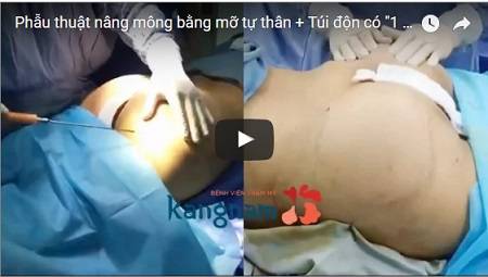 Cận cảnh quy trình nâng mông Phi Thanh Vân tại BVTM Kangnam Cận cảnh quy trình nâng mông Phi Thanh Vân tại BVTM Kangnam