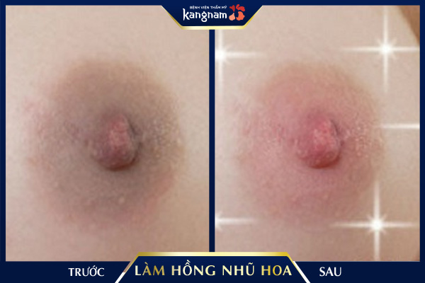 Kết quả trước và sau khi khách hàng làm hồng nhũ hoa tại Kangnam