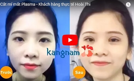 Cô nàng hóa hotgirl sau cắt mí mắt nâng mũi Sline 4D 786