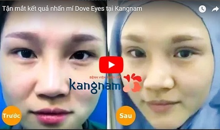 Cô nàng hóa hotgirl sau cắt mí mắt nâng mũi Sline 4D 786