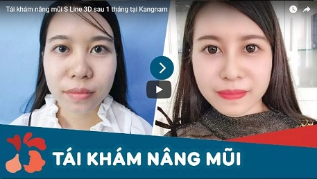 công nghệ nâng mũi s line 3d nang mui s line 3d