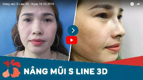 Phẫu thuật nâng mũi s line 3d tại Kangnam nâng mũi s line 3d 1