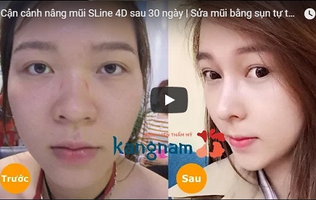 Khách hàng tái khám sau nâng mũi Sline 4D nâng mũi Sline 4D 786