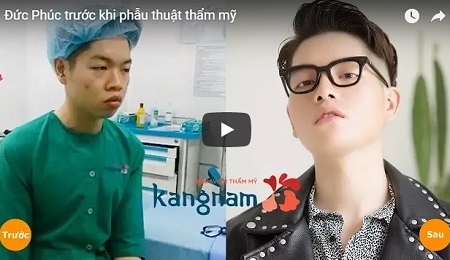 Cận cảnh quá trình nâng mũi của Đức Phúc nâng mũi Sline 4D 786