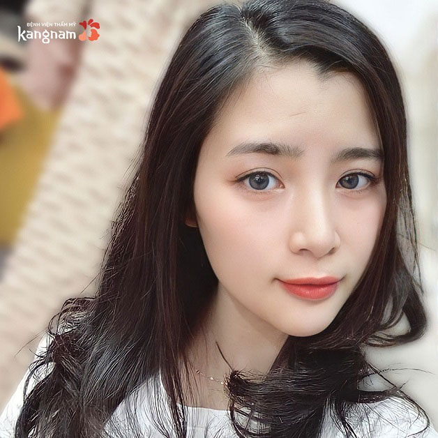 Thẩm mỹ khuôn mặt Vline 3D Hàn Quốc giúp gương mặt trở nên hoàn hảo hơn