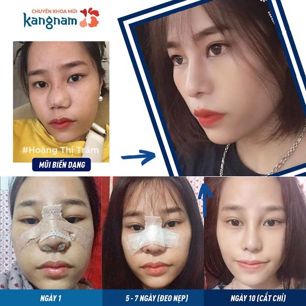 Sở hữu dáng mũi đẹp, cân đối sau tạo hình đầu mũi và cắt cánh mũi tại Kangnam