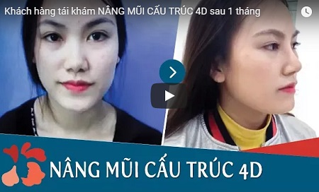 Cận cảnh quá trình nâng mũi Sline 4D tại Kangnam nâng mũi tại Kangnam