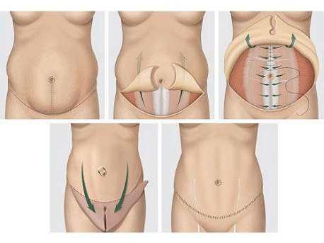 quy trình Tạo hình Body S-line
