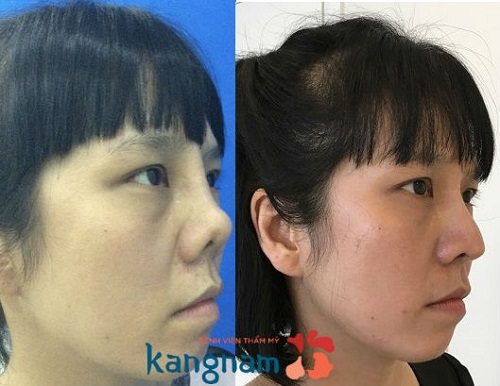 Hình ảnh nâng mũi S-line Sụn Sườn Nâng mũi S-line Sụn Sườn