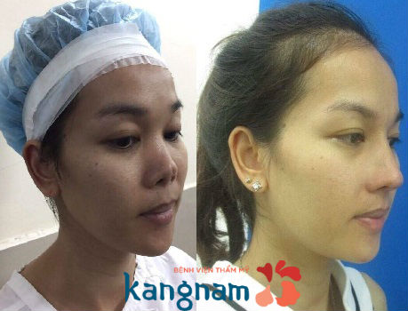 Khách hàng sau khi nâng mũi bọc sụn sườn Nâng mũi S-line Sụn Sườn 3