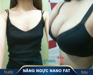Thẩm mỹ vòng 1 Nano Fat – Độc quyền tại Kangnam