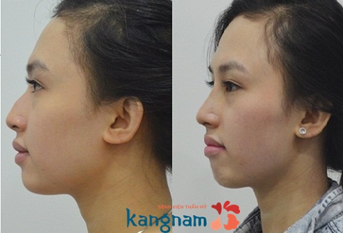 Sửa mũi gồ thường không gây ra nhiều đau đớn
