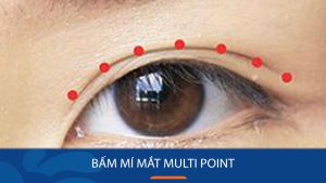 Bấm mí mắt Multi Point: Bí quyết sở hữu đôi mắt to tròn, long lanh