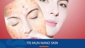 [OFF 50%] Trị mụn công nghệ Nano Skin – Sạch nhân mụn