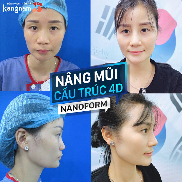 Sụn NanoForm siêu nhẹ siêu mỏng, có khả năng vặn xoắn cực đại cho dáng mũi bền đẹp