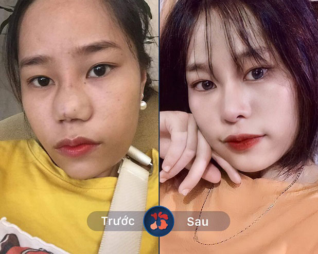 Mũi bị hỏng do tai nạn, phẫu thuật đều khắc phục thành dáng cao thẳng, đẹp sau nâng mũi cấu trúc 4D sụn NanoForm