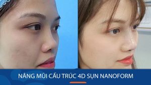 Nâng mũi cấu trúc 4D sụn NanoForm – Mũi bền vững thách thức va đập mạnh