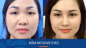 Bấm mí Dove Eyes – Giải pháp tạo mắt 2 mí Bồ Câu