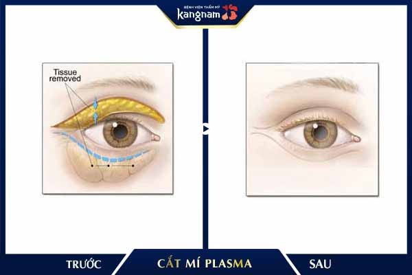 Cắt mí Plasma giúp bạn "hồi xuân" đôi mắt nhanh chóng