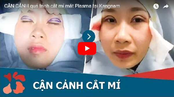 cắt mí plasma là gì