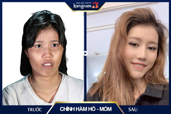 Chỉnh hàm hô móm