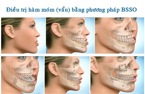 mô phỏng Chỉnh hàm hô móm