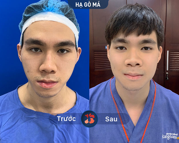 Trước và sau khi khách hàng hạ gò má