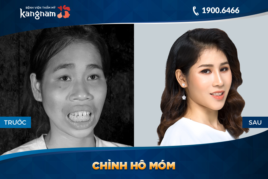Chỉnh hàm hô móm
