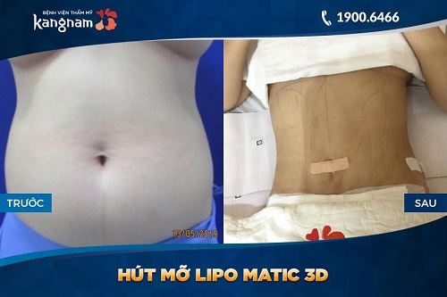 hình ảnh hút mỡ lipo matic