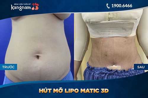 quy trình giảm mỡ