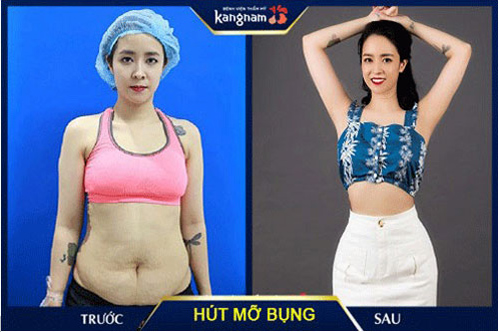 thùy dương hút mỡ