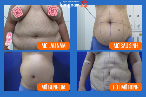 đối tượng hút mỡ