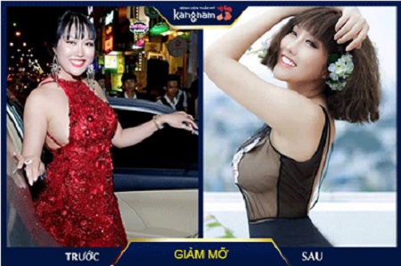 hình ảnh sau hút mỡ