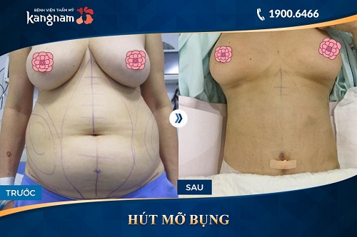 hình ảnh hút mỡ bụng