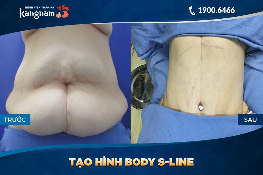 trước sau Tạo hình Body S-line