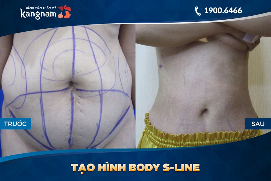 Tạo hình Body S-line tmv kangnam