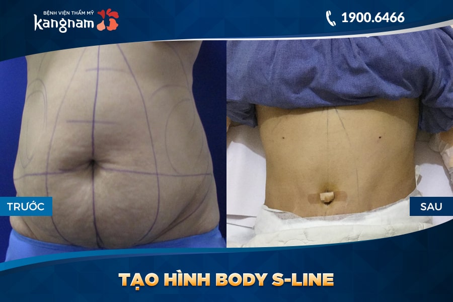 khách hàng Tạo hình Body S-line