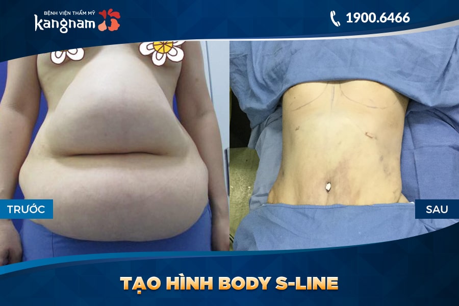 sau khi Tạo hình Body S-line