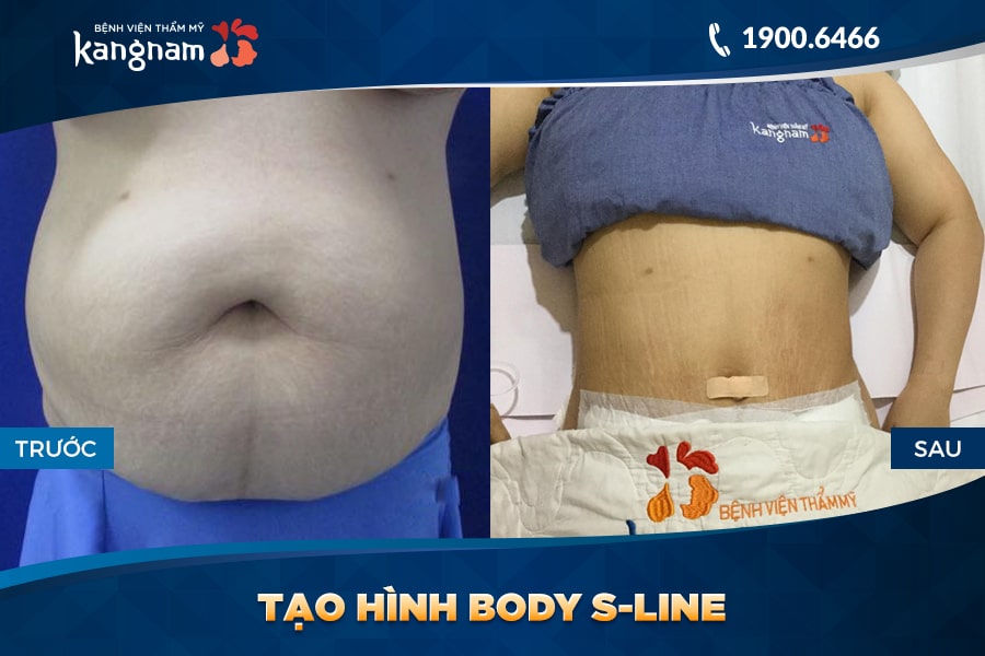 công nghệ Tạo hình Body S-line
