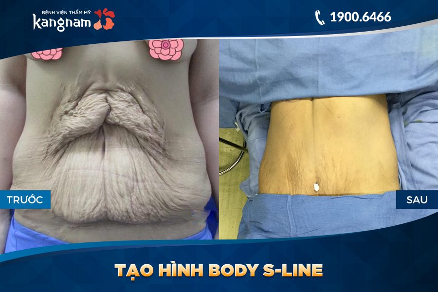 giải pháp Tạo hình Body S-line