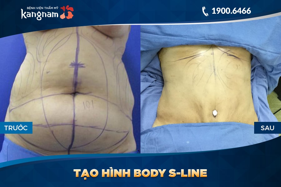 Tạo hình Body S-line bvtm kangnam
