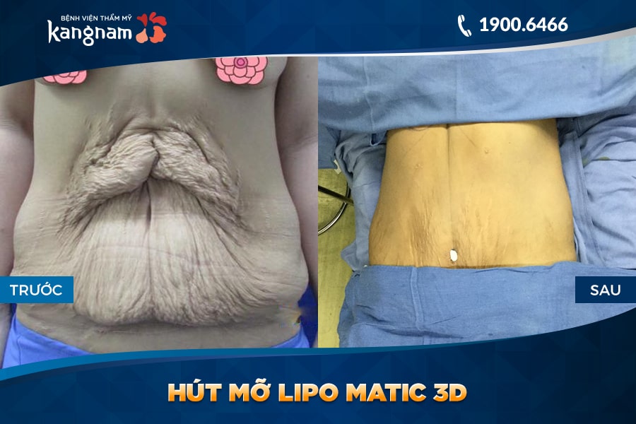 kết quả hút mỡ lipo matic