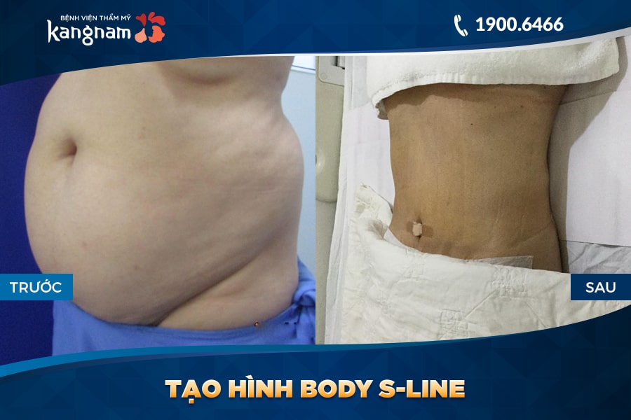 kết quả Tạo hình Body S-line