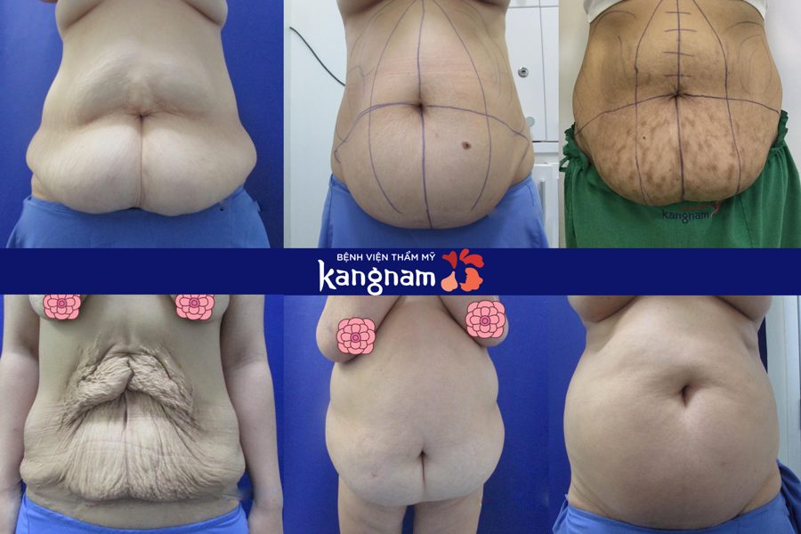 Tạo hình Body S-line kangnam