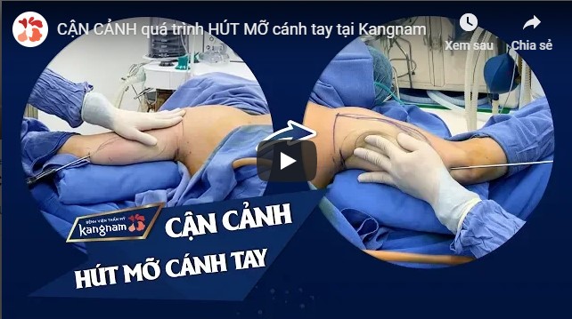 video hút mỡ bắp tay