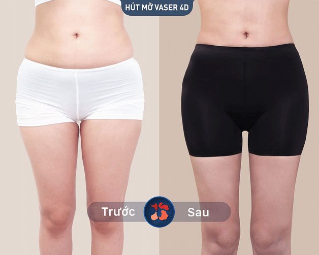 Vòng eo trở nên thon gọn và quyến rũ hơn sau khi khách hàng thực hiện hút mỡ tại Kangnam