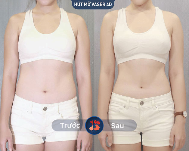 Trước và sau khi khách hàng hút mỡ, eo trở nên thon gọn và quyến rũ
