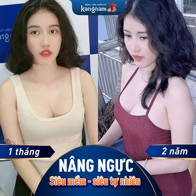 Ngực bền đẹp sau năng, bảo toàn các chức năng sinh đẻ